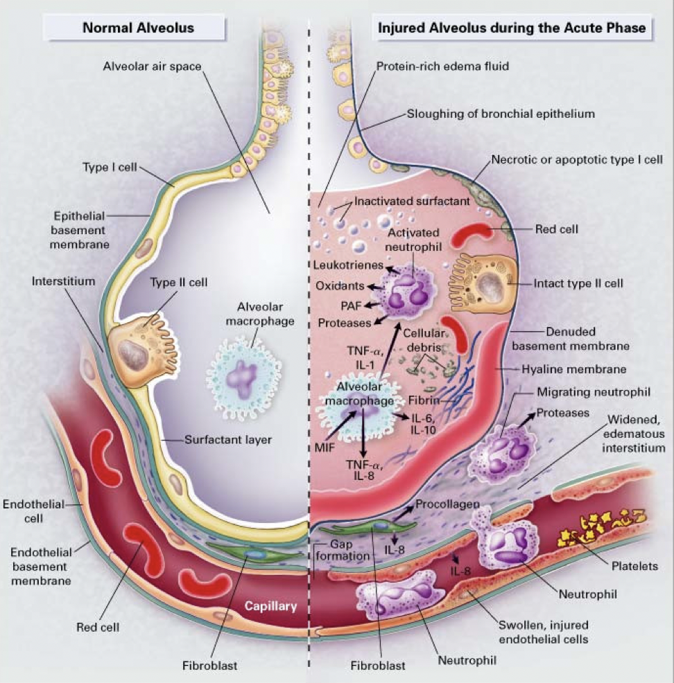 Critical Care Lung Injury Ucsf Pulmonary Critical Care Allergy And